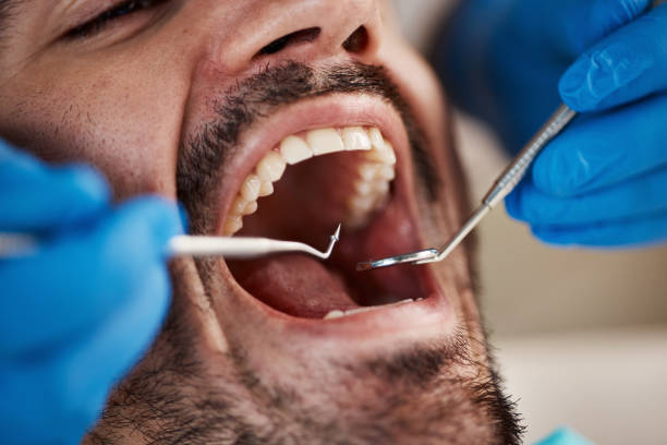 Best Emergency Root Canal Treatment in Hawkins, TX