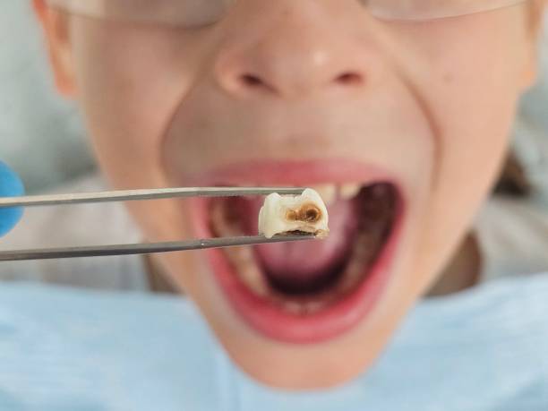 Best Urgent Dental Care for Toothache in Hawkins, TX